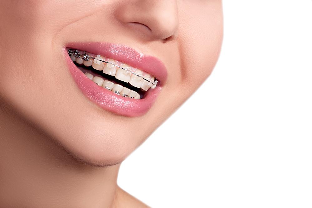 Adult Orthodontics