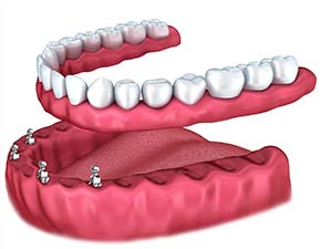 Implant Dentistry for Slipping Dentures
